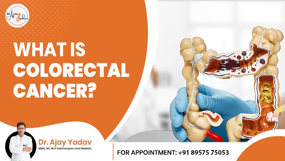 What Is Colorectal Cancer?