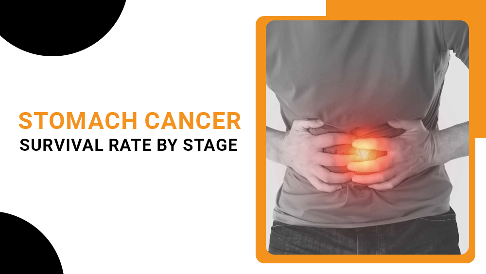 Stomach cancer survival rate by stage