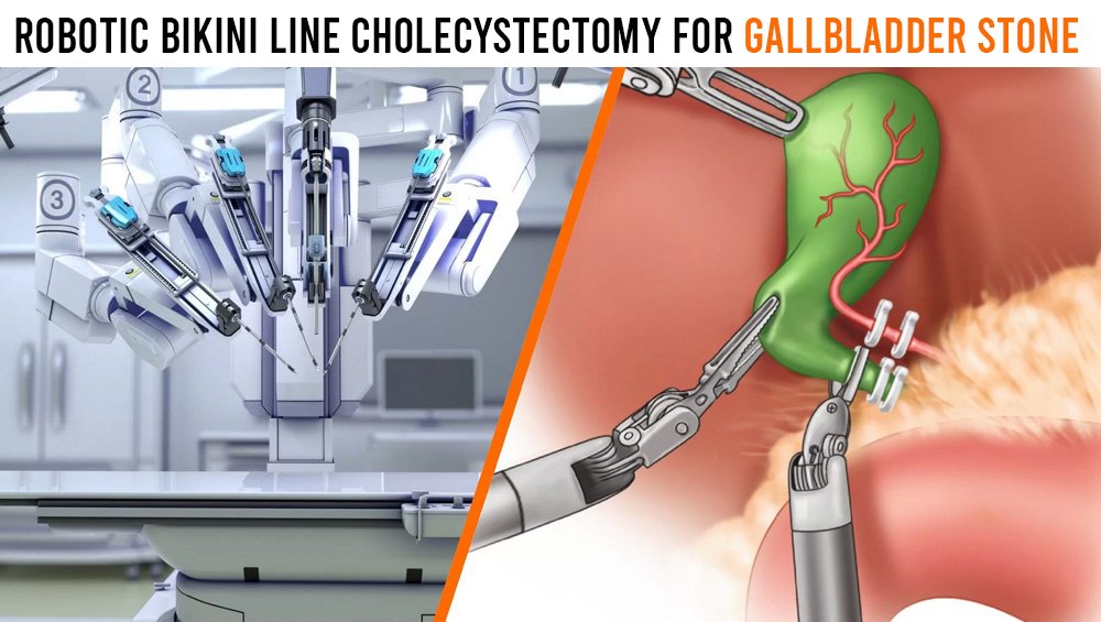 Robotic Bikini Line Cholecystectomy for Gallbladder Stone