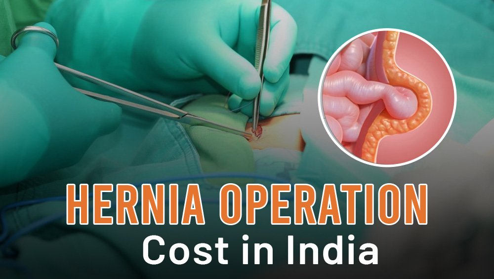 Hernia Operation Cost in India: A Simple Guide for Patients