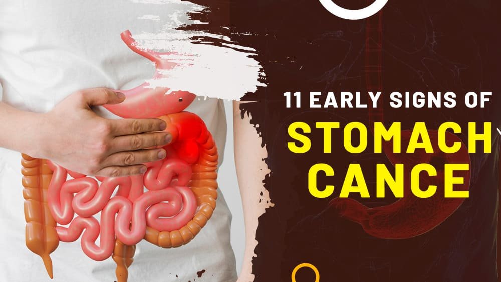 11 Early Signs of Stomach Cancer