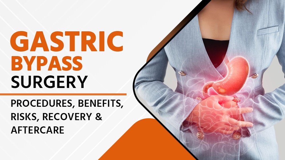 Gastric Bypass Surgery: Procedures, Benefits, Risks, Recovery, and Aftercare
