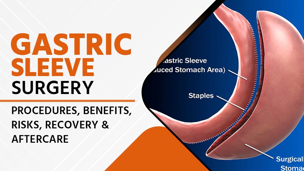 Gastric Sleeve Surgery: Procedure, Benefits, Risks, Recovery, and Aftercare